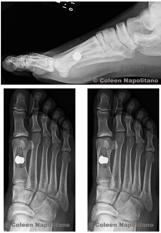imaging of foot with bullet