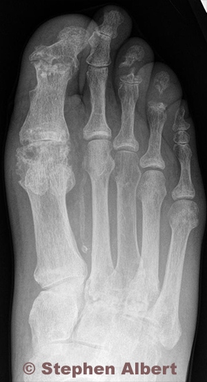 imaging of foot with gouty arthritis