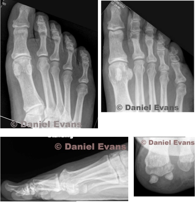 imaging of foot with osteoarthritis